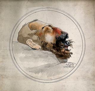 Syphilis:  Face of a Dead Man with Erosion of the Nose